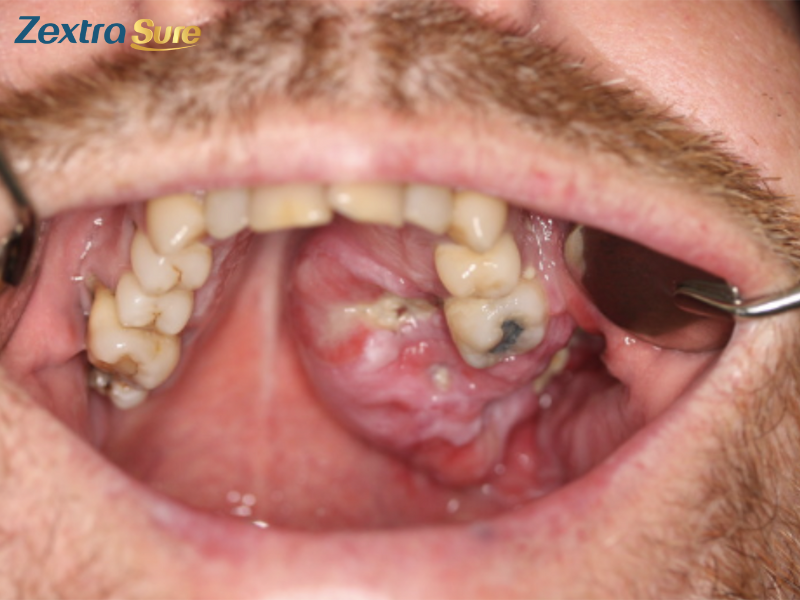 jaw-cancer-symptoms (5)